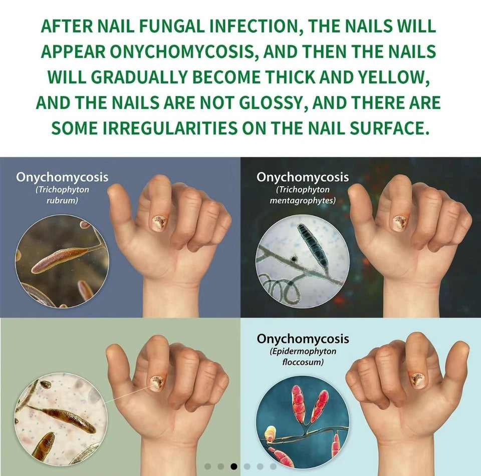 7-Day Toenail Fungus Treatment 2-Pack – Extra Strength Repair for Discolored Nai