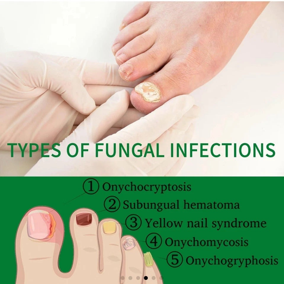 7-Day Toenail Fungus Treatment 2-Pack – Extra Strength Repair for Discolored Nai